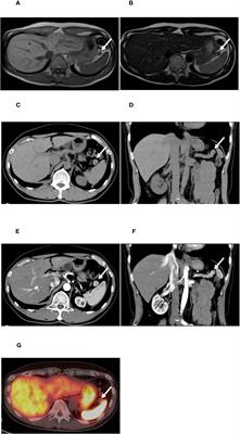 18F-labeled PEGylated exendin-4 imaging noninvasively differentiates insulinoma from an accessory spleen: the first case report of [18F]FB(ePEG12)12-exendin-4 positron emission tomography/computed tomography for insulinoma